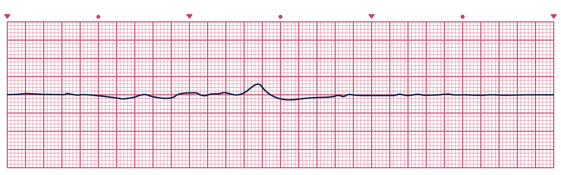 An ECG depicting Asystole