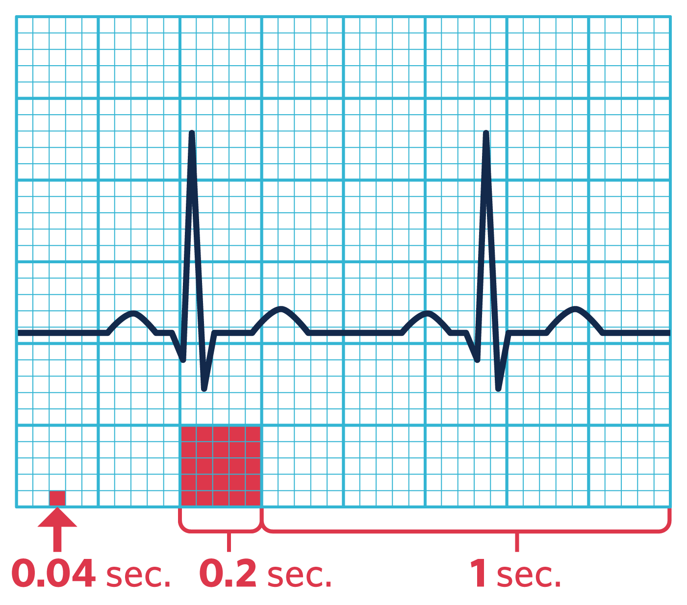 An ECG on a grid illustrating time intervals