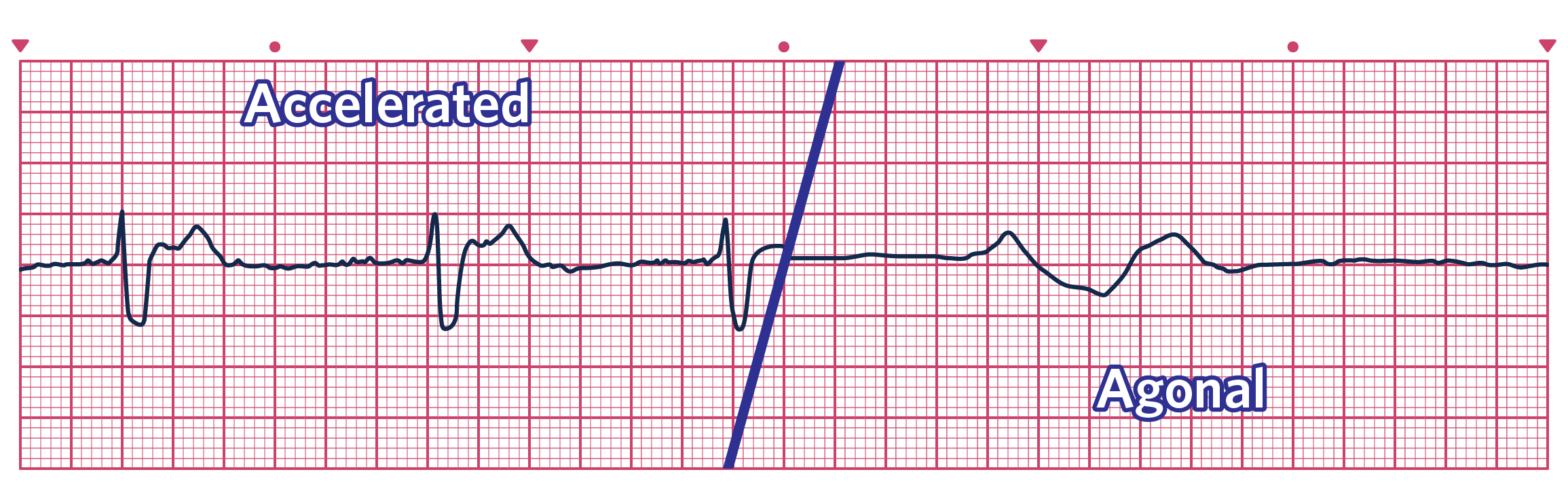 An ECG depicting Idioventricular Rhythms