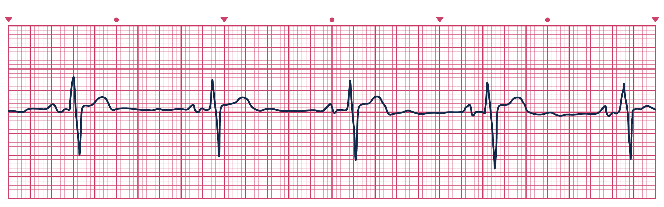 An ECG depicting Sinus Bradycardia
