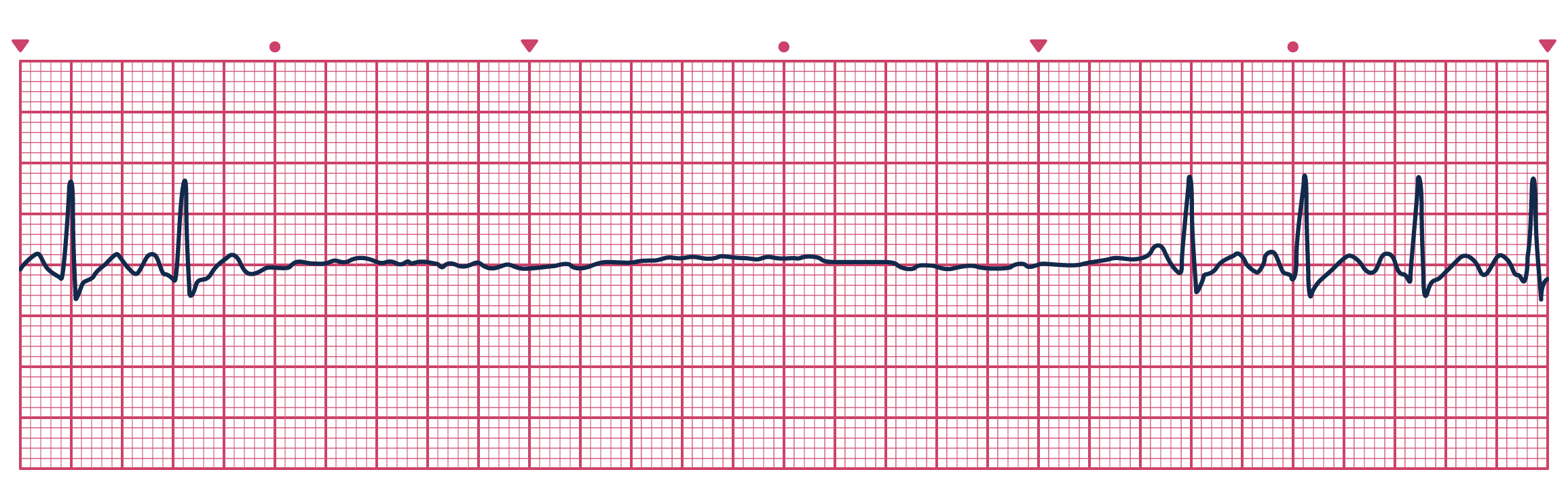 An ECG depicting Sinus Pause