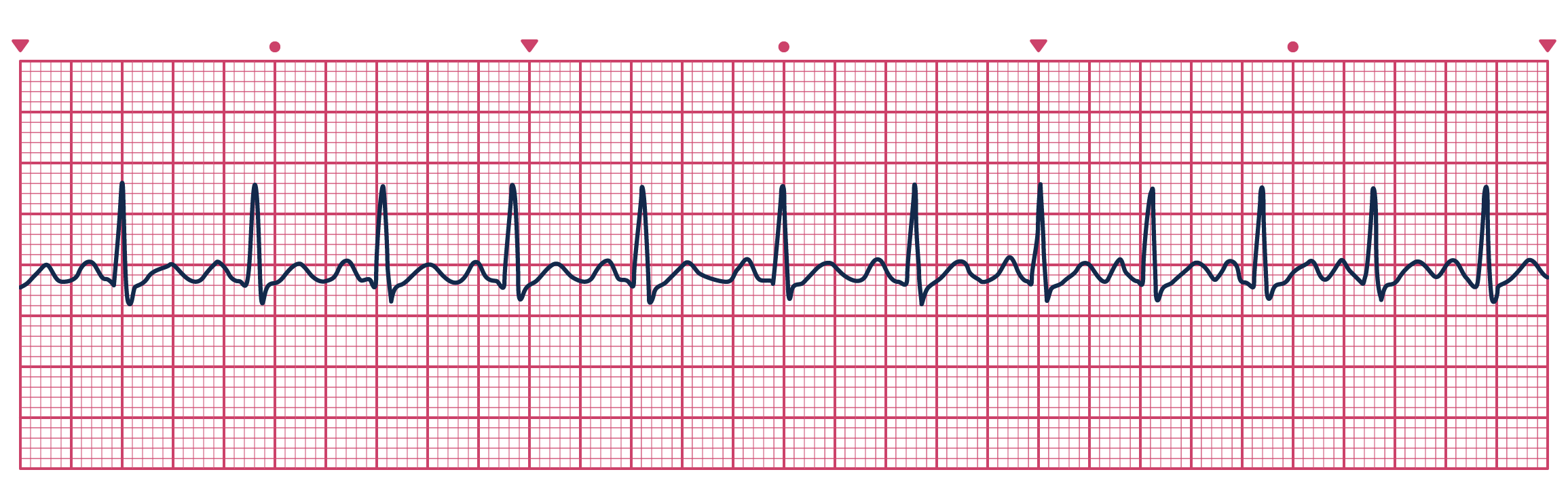 An ECG depicting Sinus Tachycardia