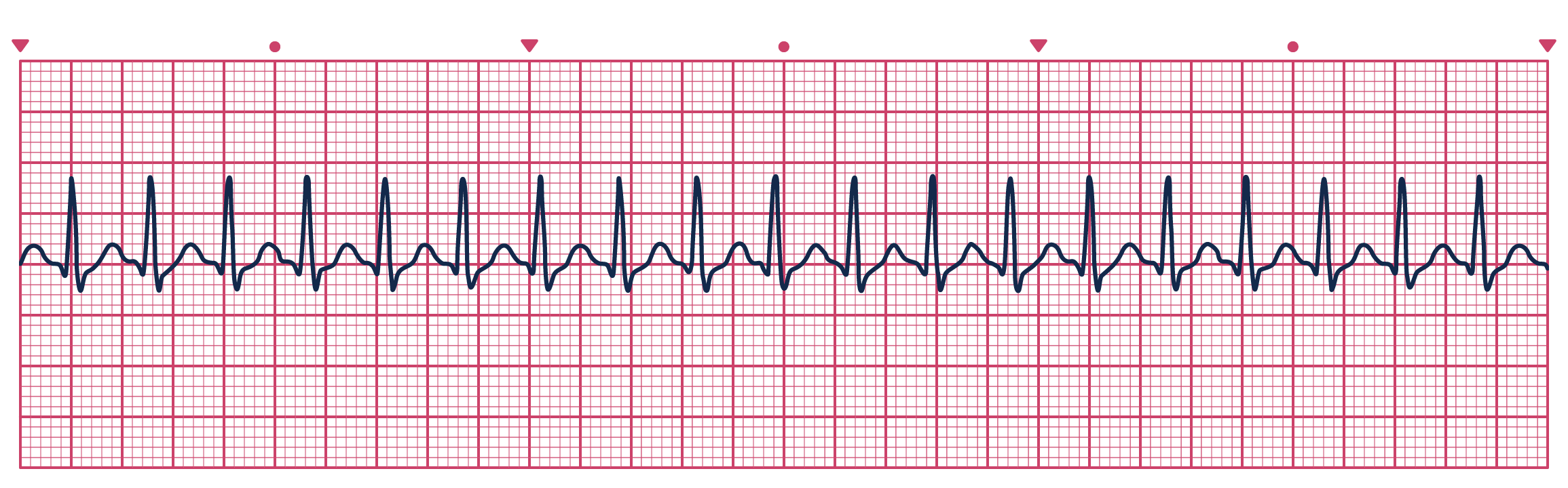 An ECG depicting Supraventricular Tachycardia