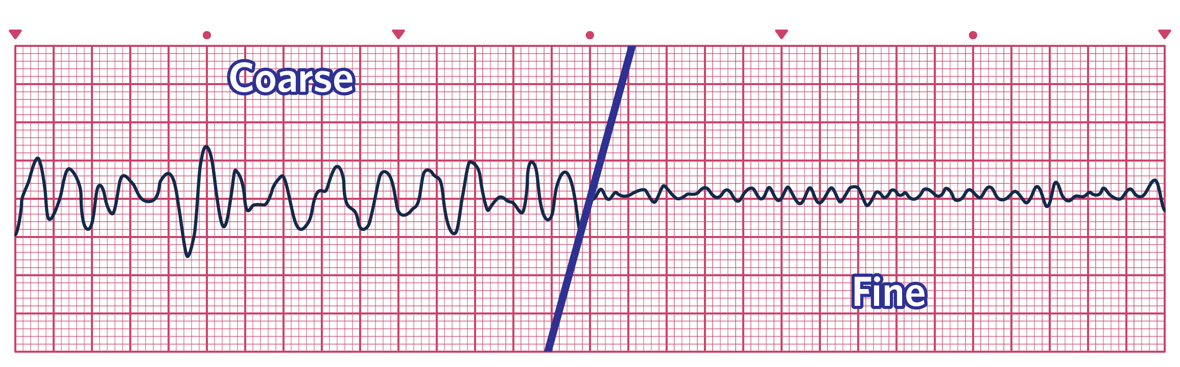 An ECG depicting Ventricular Fibrillation