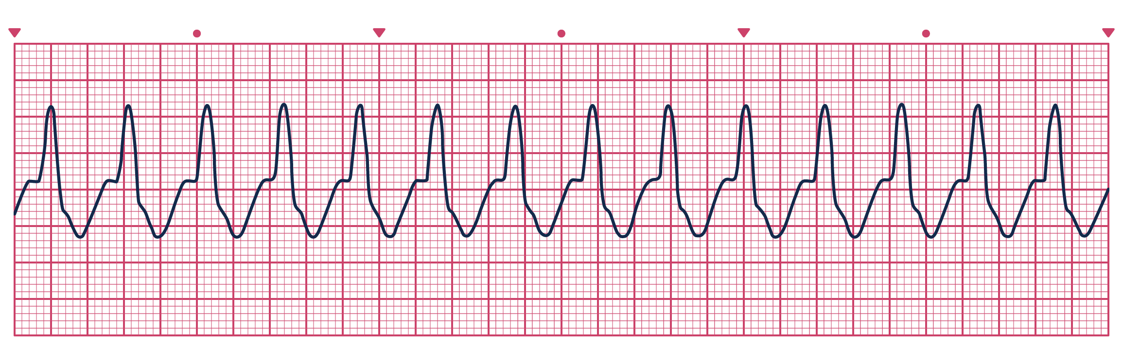 An ECG depicting Ventricular Tachycardia